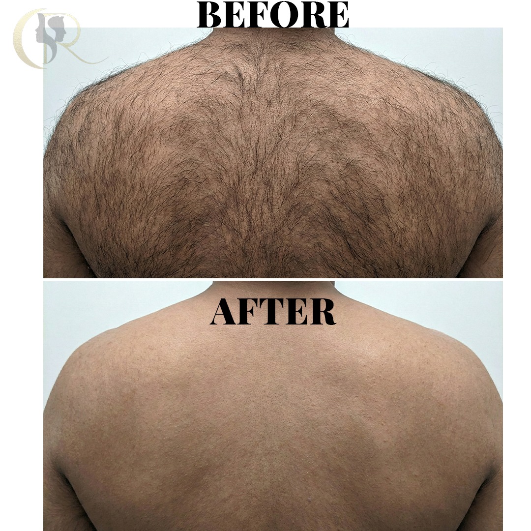 Cosmo Radiance result: Full Back Hair Clearance